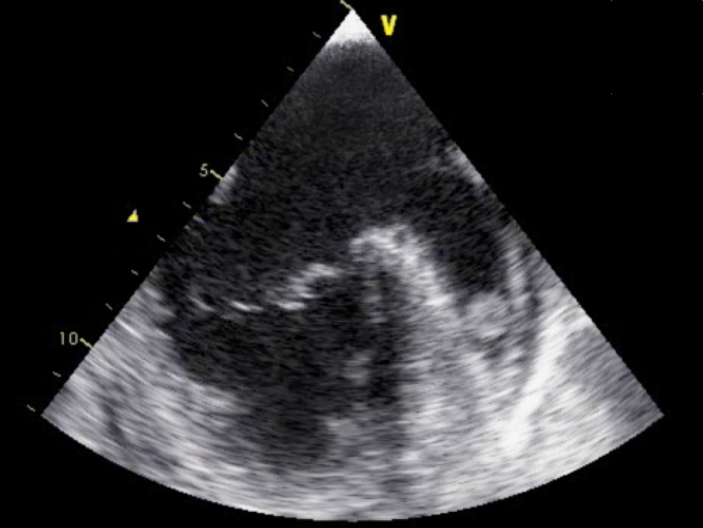Ein rundes Blutgerinnsel hat sich im linken Vorhofohr gebildet. Darstellung mit transösophagealem Ultraschall.