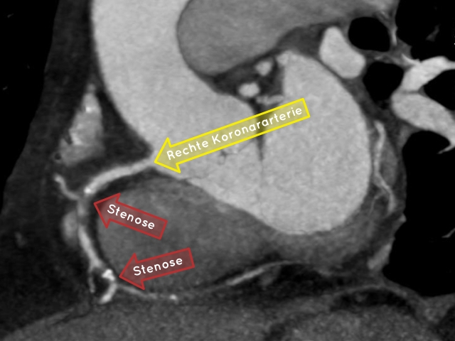 Eine rechte Koronararterie zeigte eine Tandem-Stenose (siehe Abschnitt: Koronarangiographie) sowie eine weitere Engstelle. 