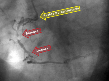 Eine rechte Koronararterie zeigt eine Tandem-Stenose (gleicher Patient wie im Abschnitt: Computertomographie).